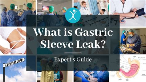 gastric sleeve leak|Gastric Leak Post